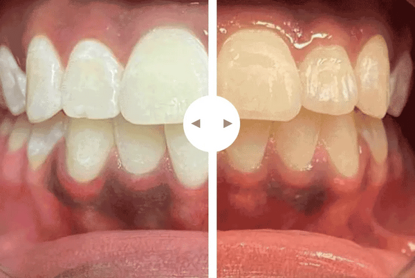 Sonrisa Brillante Eloura Fácil Rápida