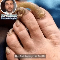 Kora Tratamiento Antihongos Uñas
