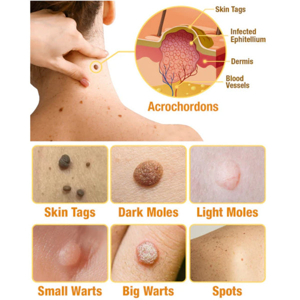 Spray Mágico para Verrugas